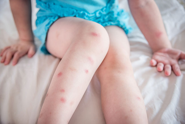 Bed bug bites on child